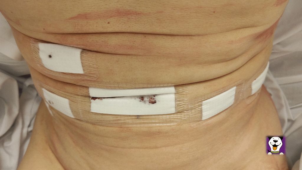 Incisions in abdomen after radial prostatectomy.